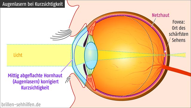 Augenlasern Lasik Verfahren Kosten Risiken