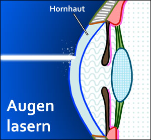 Augen Lasern In Esslingen Kosten Kliniken